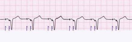 Il MAC 5500 HD offre nuove interpretazioni 12SL del ritmo cardiaco normalizzato dal pacemaker. MUSE v8 visualizza gli ECG memorizzati per una successiva analisi.