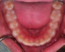 L anamnesi medica e quella odontoiatrica non rivelano alcunché di patologico e i risultati dell esame dell articolazione temporo-mandibolare (ATM) sono normali, con movimenti mandibolari ben