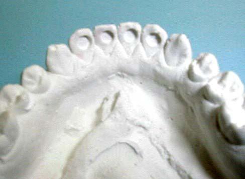 Placca inferiore per la protrusione degli incisivi senza modello di set-up Se i denti sono già allineati nell arcata e, per esempio, devono solo essere protrusi, si