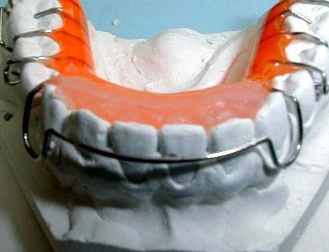 Modello con raschiature rotonde Placca parzialmente alloggiata I denti vengono raschiati in modo da creare delle concavità che vengono poi riempite con silicone,