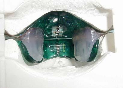 Modello con placca inferiore e bordo inclinato per la guida del silicone Parte laterale in silicone nel mascellare superiore Dapprima, nel mascellare