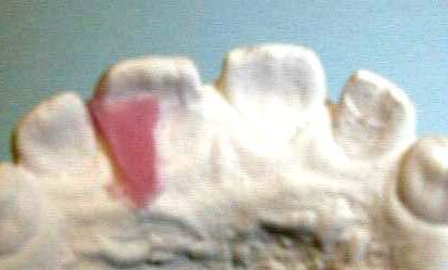 Combinazione di silicone e vite per la rotazione e la protrusione di 2 mm del dente 11 Per la rotazione il dente viene cerato in modo