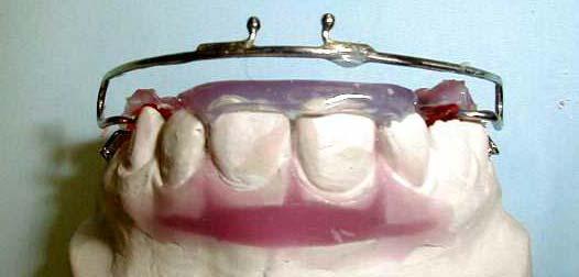 Allungamento di 2 mm dei denti 12, 21 Dopo la realizzazione di una placca superiore con arco antagonista, i due incisivi vengono