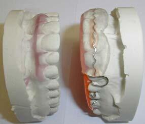 necessario riposizionare gli incisivi in combinazione con l intrusione di denti