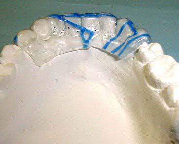 Placca stampata inferiore per il riposizionamento degli incisivi, correzione di rotazioni e chiusura di spazi di denti singoli Il riposizionamento di denti singoli è possibile anche mediante una