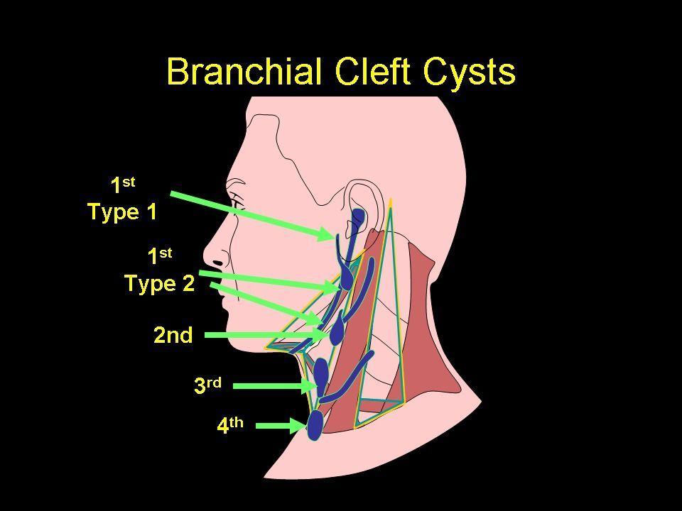 Branchial Malformations Classification of branchial anomalies Congenital anomalies of the neck arise as a