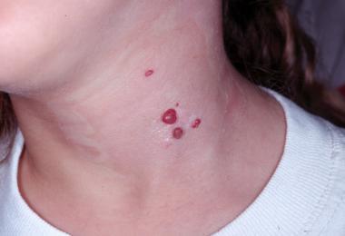 Thyroid Hemangiomas