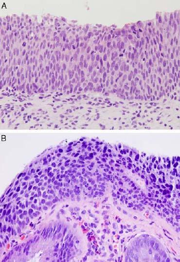 Lesioni squamose intra-epiteliali H-SIL - Proliferazione di cellule anormale - Atipia nucleare (ingrandimento, aumento del rapporto nucleo/citoplasma, pleomorfismo,