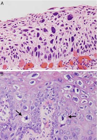 Lesioni squamose intra-epiteliali Circostanze speciali - MITOSI ANOMALE O ATIPIA NUCLEARE MARCATA - Anche se localizzate solo al terzo inferiore,