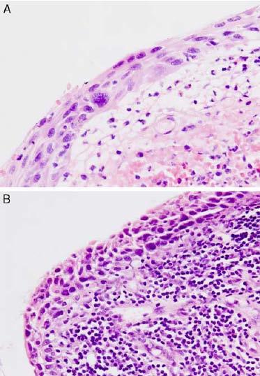 Lesioni squamose intra-epiteliali Circostanze speciali - SIL SOTTILE - Lesioni intraepiteliali immature di meno di 10 cellule di spessore - Il grado di atipia