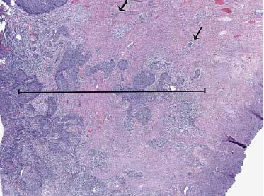 Carcinoma di cellule squamose superficialmente invasivo Raccomandazione #4: SISCCA CERVICE DEFINIZIONE: CARCINOMA SQUAMOSO INVASIVO LESIONE NON VISIBILE MACRO PROFONDITA DI