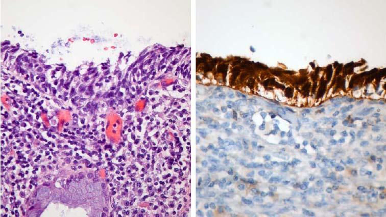 BIOMARCATORI Diagnosi differenziale HSIL