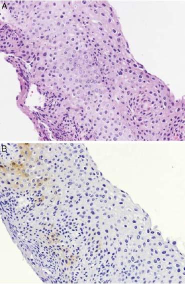 atipia riparativa Diagnosi