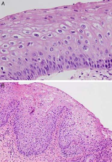 Lesioni squamose intra-epiteliali L-SIL - Proliferazione di cellule anormale - Atipia nucleare (ingrandimento, aumento del rapporto nucleo/citoplasma, pleomorfismo, cromatina irregolare, bordi