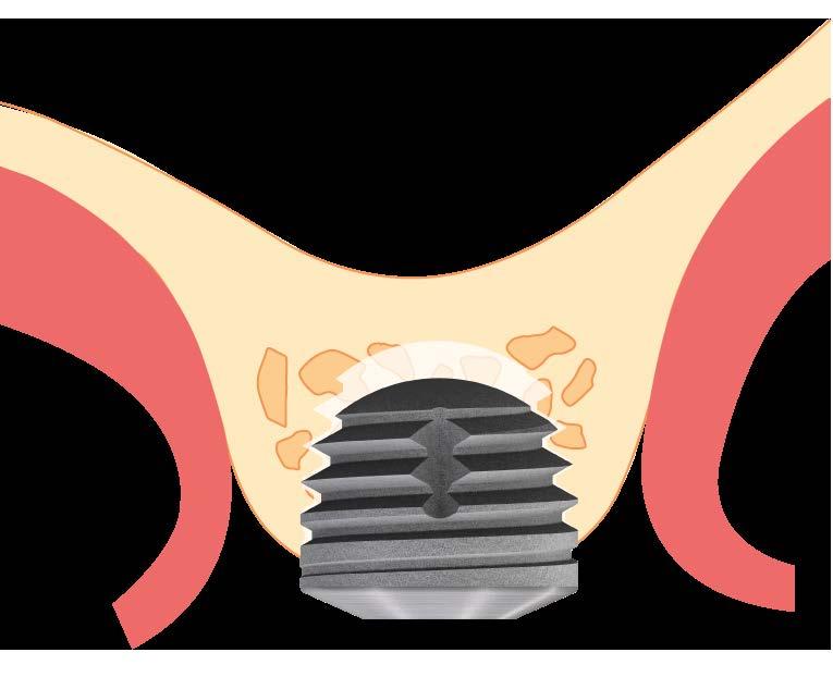 Tissue Related Implant Management Protocollo