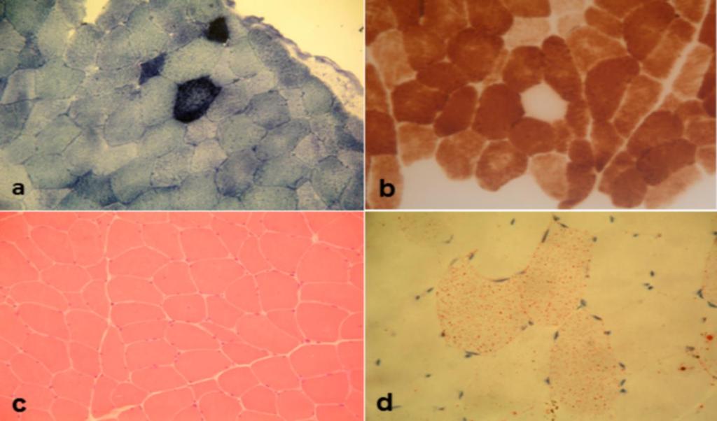 Presentazione del caso : indagini Biopsia muscolare Risultati istologici e istochimici nella biopsia muscolare: Lo studio di SDH-istochimica (a) mostrava una proliferazione mitocondriale con alcune