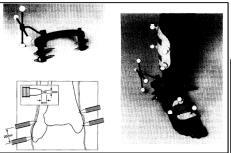 4.3.3 Tecniche basate su marcatori percutanei A differenza dei fili intracorticali che vengono inseriti nell osso, i marcatori percutanei scheletrici consistono in un numero di viti inserite nel