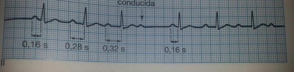 ECG