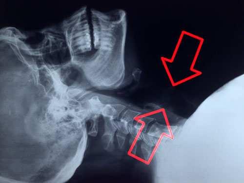 TRACHEA Parte cervicale La faccia dorsale è in rapporto con l esofago