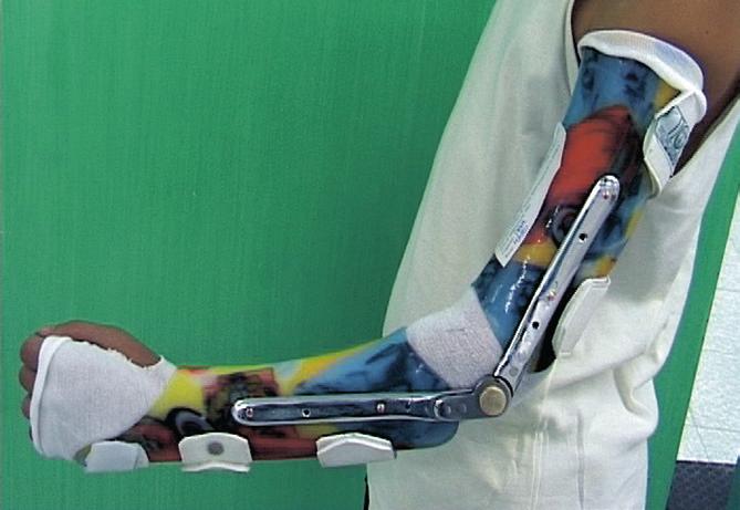 Il tutore braccio e avambraccio a valva posteriore viene costruito rilevando l impronta in gesso negativo-positivo.