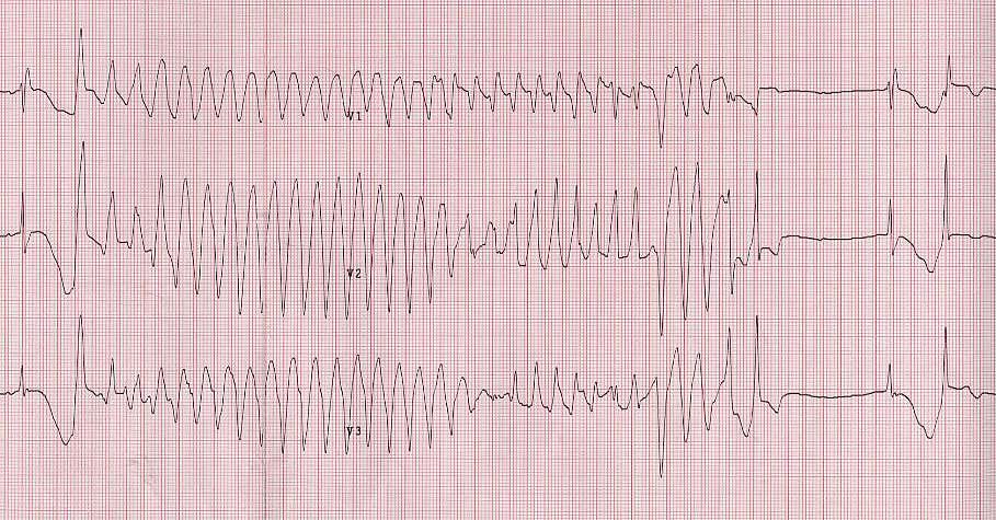 Donna 34 anni, terapia con metadone, tre episodi