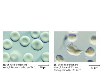 L anemia falciforme (a) Eritrociti contenenti emoglobina normale Hb A Hb A (b) Eritrociti contenenti emoglobina falciforme (emoglobina S) Hb S