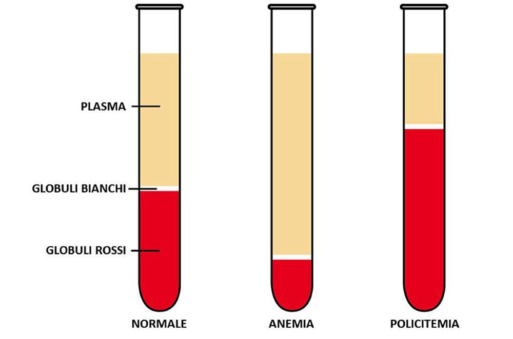 Anemie e Policitemie Un numero troppo basso di eritrociti determina l anemia, in genere dovuta a carenza dietetica di ferro o di vitamina B12 o di acido folico (vit. B9).
