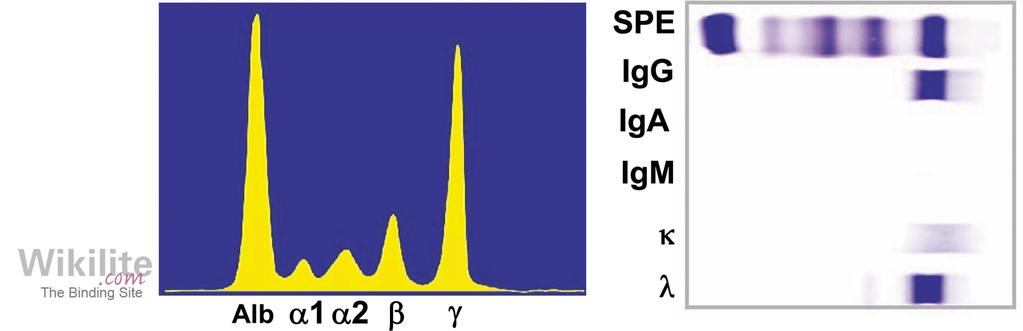 elettroforesi delle proteine del siero (SPE) e delle urine (UPE), seguite da immunofissazione sierica (sife) e urinaria (uife).