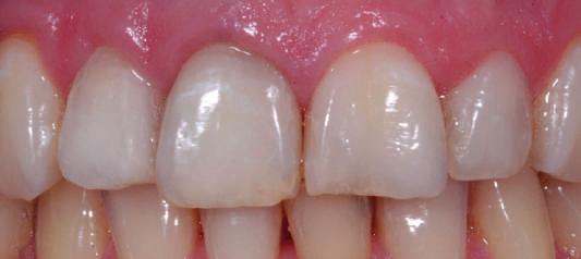 trattamenti sbiancant dei denti devitali ed evitare le recidive realizzare le mascherine secondo la tecnica MOBI e consegnare i trattamenti sbiancanti domiciliari;