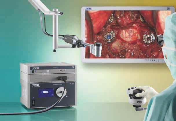 VITOM 3D Visualizzazione 3D per la chirurgia aperta della colonna vertebrale Il sistema VITOM 3D rappresenta una soluzione rivoluzionaria per la visualizzazione di interventi microchirurgici e di