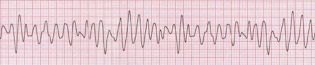 DEFINIZIONI Morte Cardiaca Improvvisa?