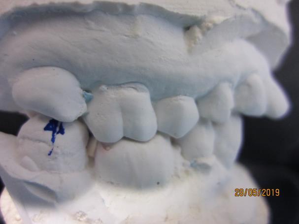l attivazione propriocettiva dei denti frontali per scaricare i