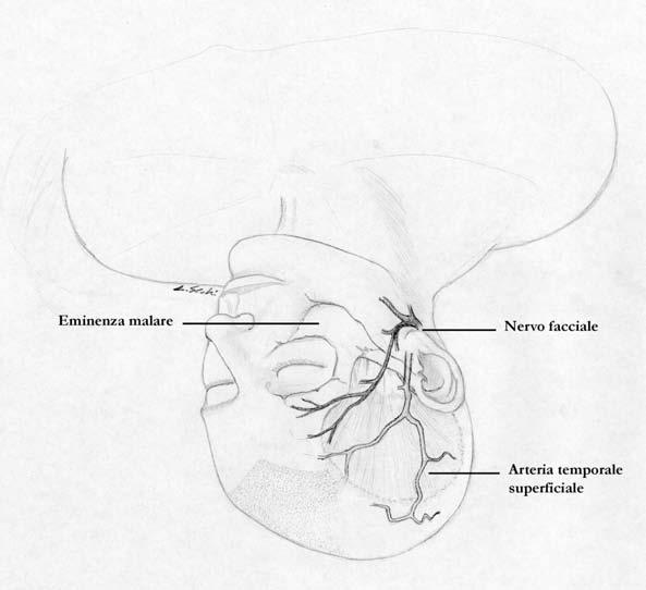 10 Approcci chirurgici al basicranio Incisione cutanea Figura 1 L incisione cutanea è curvilinea e centrata nel key-hole (punto di repere situato sulla sutura fronto sfenoidale, 1 cm posteriormente