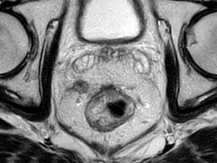 RM addome inferiore (30/11) risposta significativa alla terapia