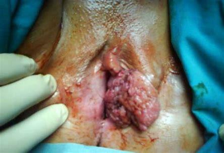 7 Carcinoma vulvare Totale complicanze post-chirurgiche: 41.
