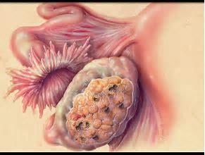 9 Carcinoma ovarico Totale complicanze post-chirurgiche: 26.