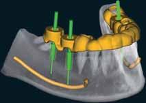 SOFTWARE ZIRKONZAHN.IMPLANT-PLANNER Il software Zirkonzahn.