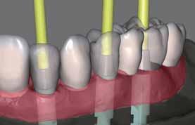 Implant-Planner: pacchetto per l odontoiatra con modello fresato, porta-impronte individuale, guida chirurgica e provvisorio MODULO SOFTWARE CAD/CAM PONTI AVVITATI