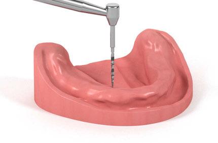 2.4 Inserimento dell impianto Stabilizzazione di una protesi mandibolare Nella mandibola sono necessari almeno quattro impianti Straumann Mini Implants.