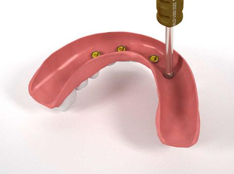 Optiloc ). Passaggio 4.