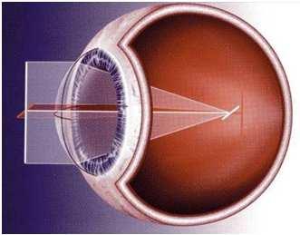 Entrambe le focalinesono prima della retina (miopia) o