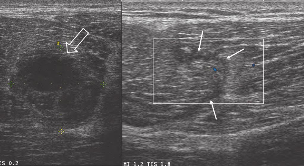 Radio MSK - n 9 - maggio 2017 43 A B Figura 24. Voluminosa lesione muscolare del bicipite femorale con ematoma (freccia vuota).