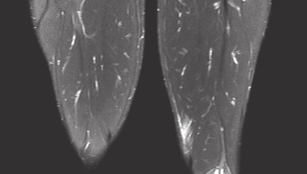 26 L Imaging della Lesione Muscolare Acuta - E. Genovese Figura 9. Lesione del semimembranoso di sinistra.