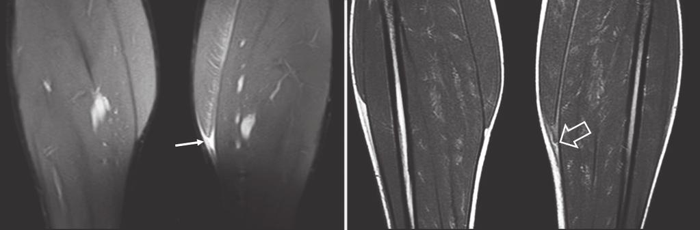 28 L Imaging della Lesione Muscolare Acuta - E. Genovese A B Figura 12. Lesione del gastrocnemio mediale.