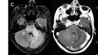 dismetria in AS sin, nistagmo nello sguardo eccentrico Peggioramento del quadro clinico nei 2 mesi