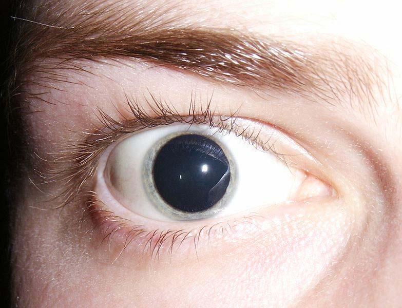 Muscoli intra oculari: midriasi 20 Muscolo dilatatore della pupilla Midrìasi (condizione fisiologica di dilatazione della pupilla in assenza di luce) Permette l'ingresso di stimoli luminosi