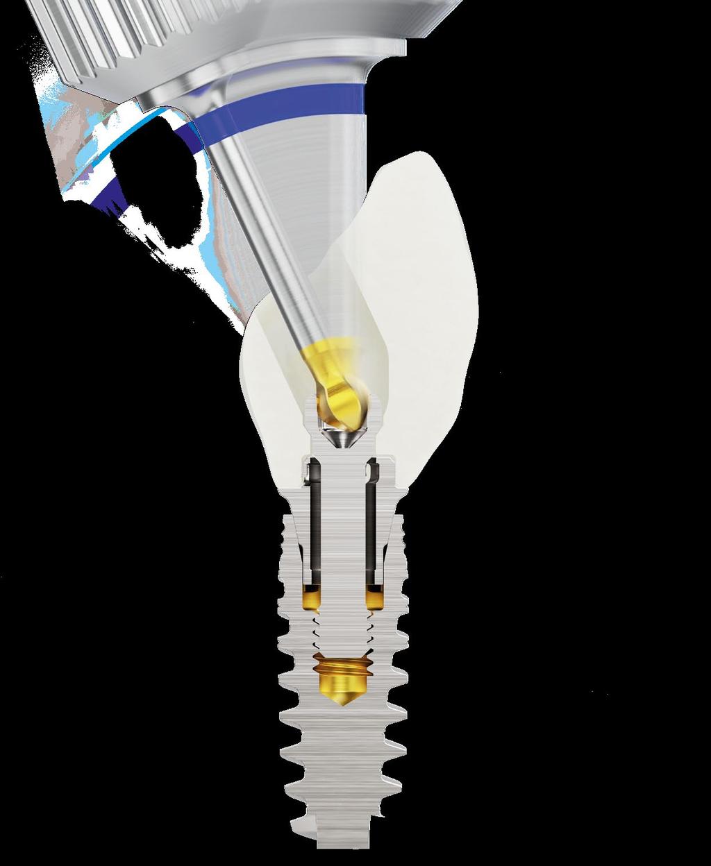 Canale della vite angolato (ASC) Accedi con facilità alla protesi quando lo spazio verticale è limitato, consentendo una funzione occlusale ottimale.