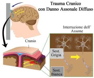 Traumi cranici La lesione assonale diffusa E la conseguenza dell effetto diffuso della forza traumatica all intera massa encefalica.