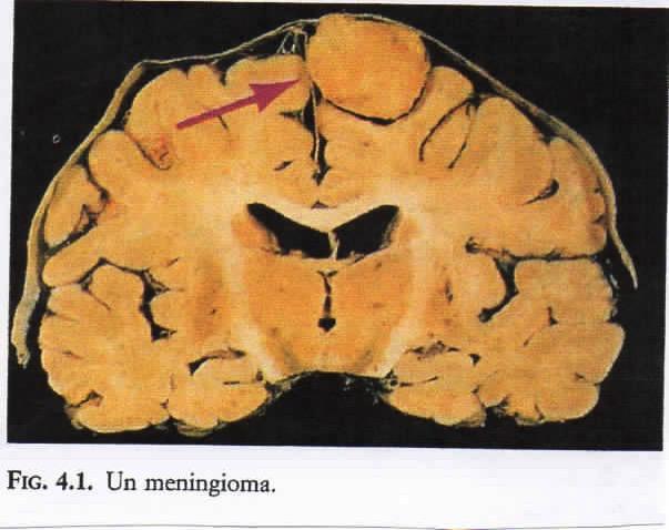 Cause di lesioni cerebrali: Tumori Cerebrali E una massa cellulare che cresce indipendentemente dal resto del corpo.