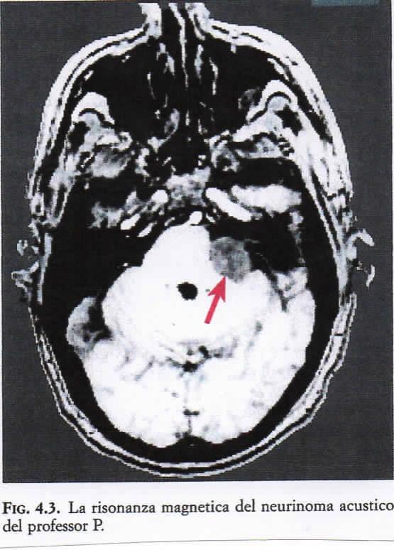 Cause di lesioni cerebrali: Tumori Cerebrali La presenza di una capsula fibrosa rappresenta l eccezione e non la regola. La maggioranza dei tumori cerebrali sono infiltranti.